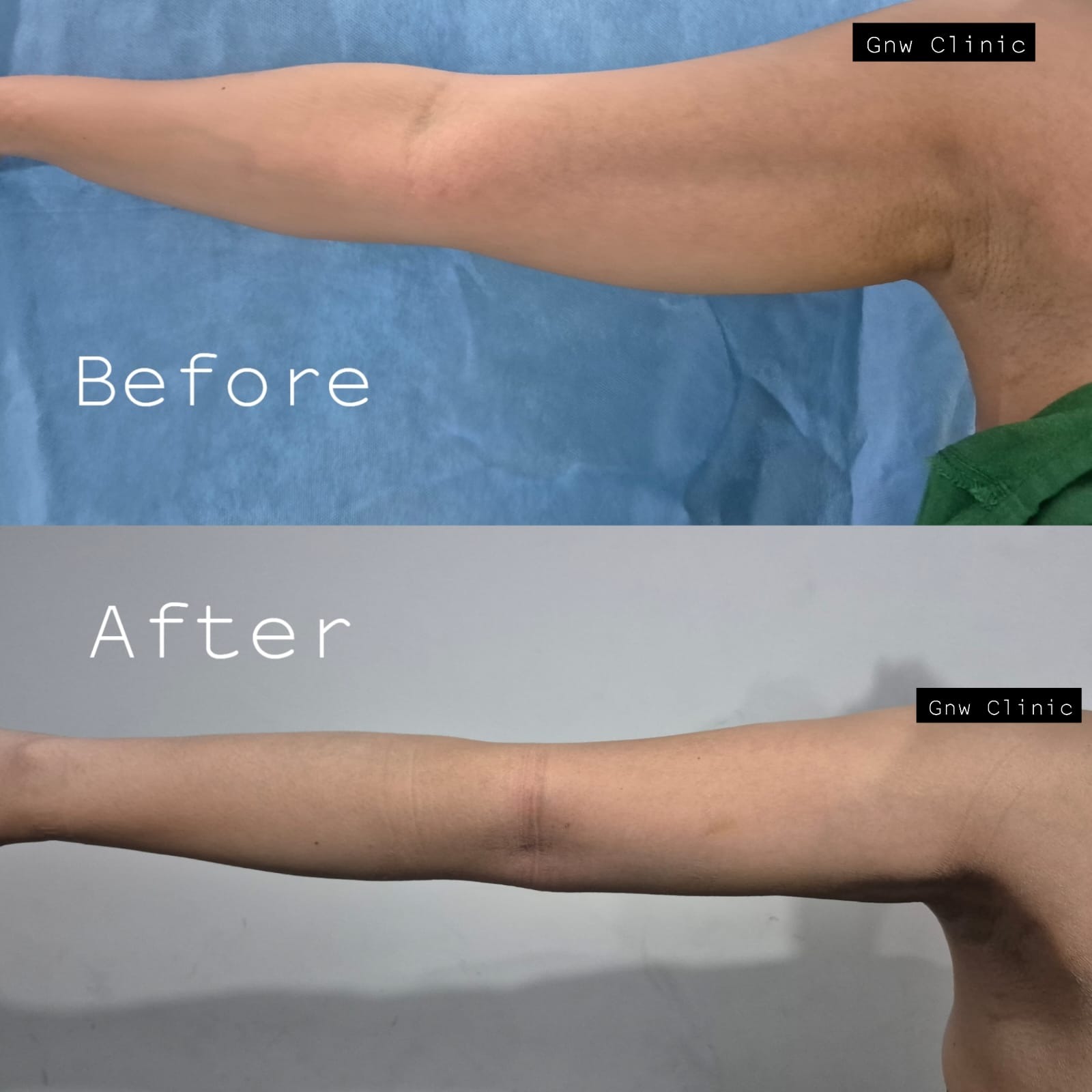 Before after kontur lengan